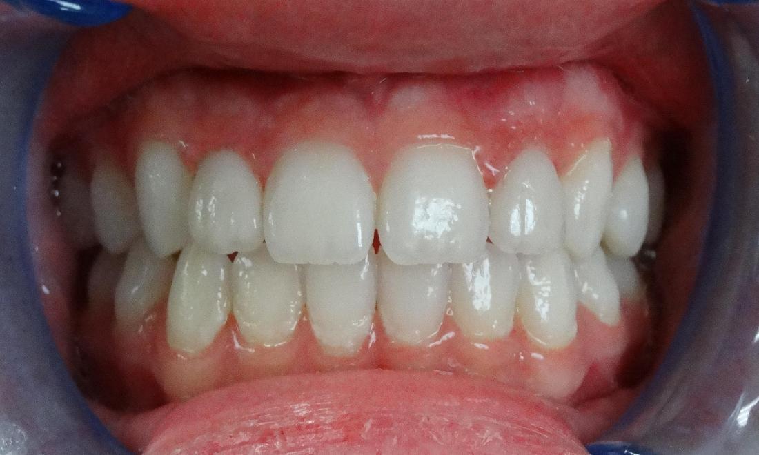 after - small, misaligned lateral incisors have a much nicer appearance