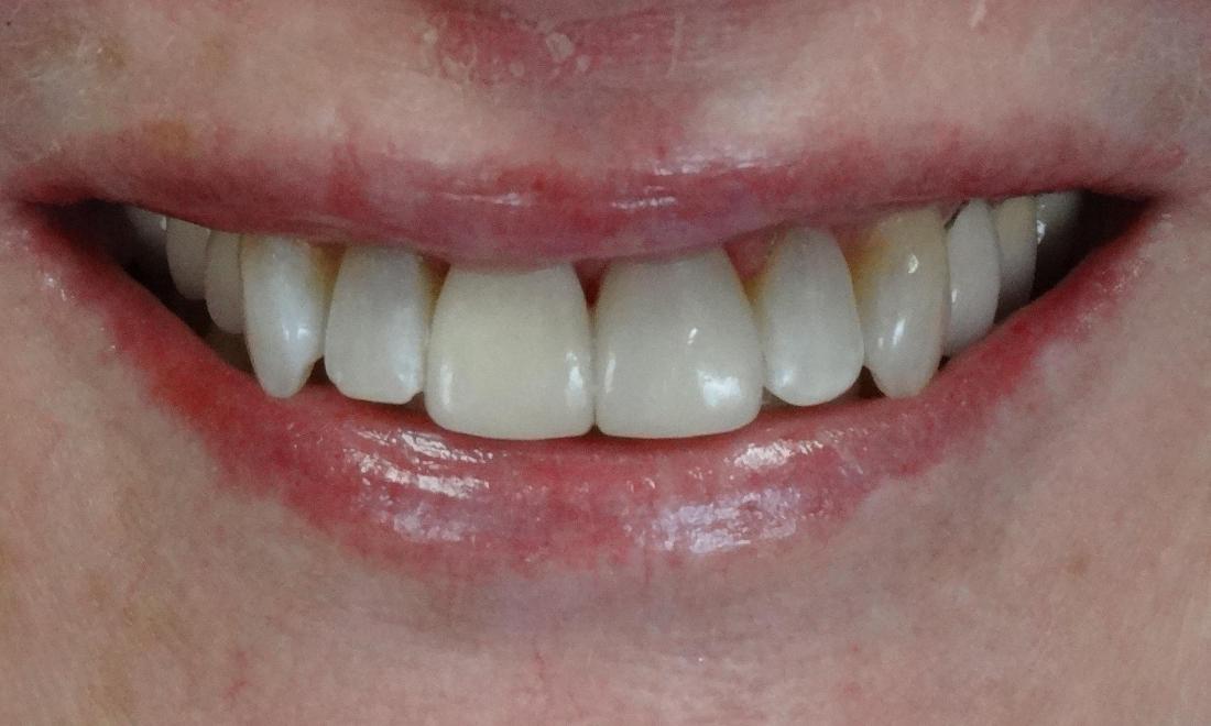 after veneers lakeland family dental oconomowoc wi dentist