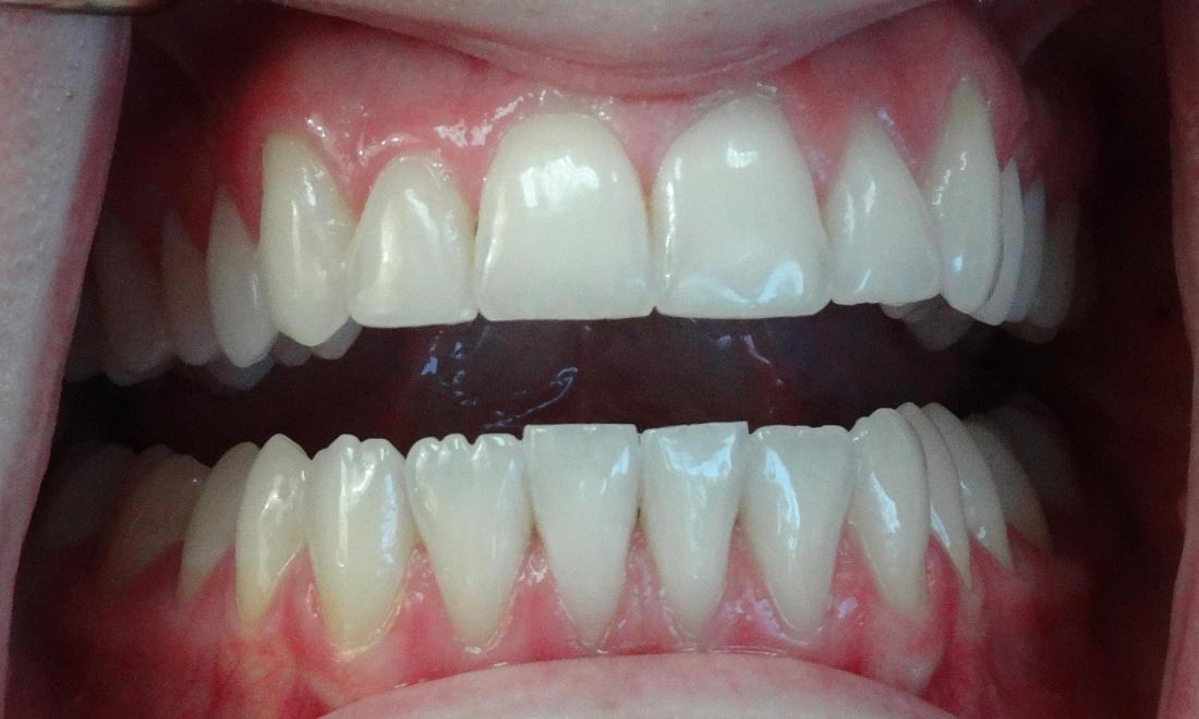 teeth edge bonding near me