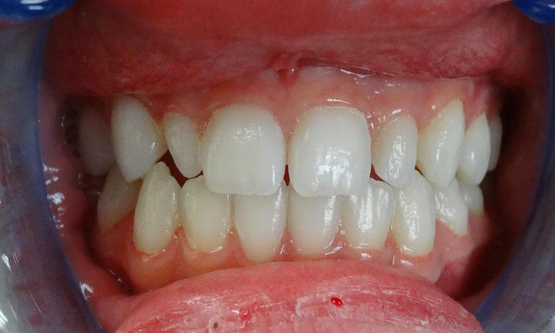 before - small, misaligned lateral incisors