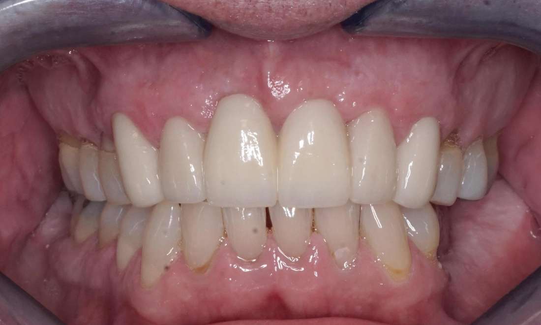 anterior bridge, after