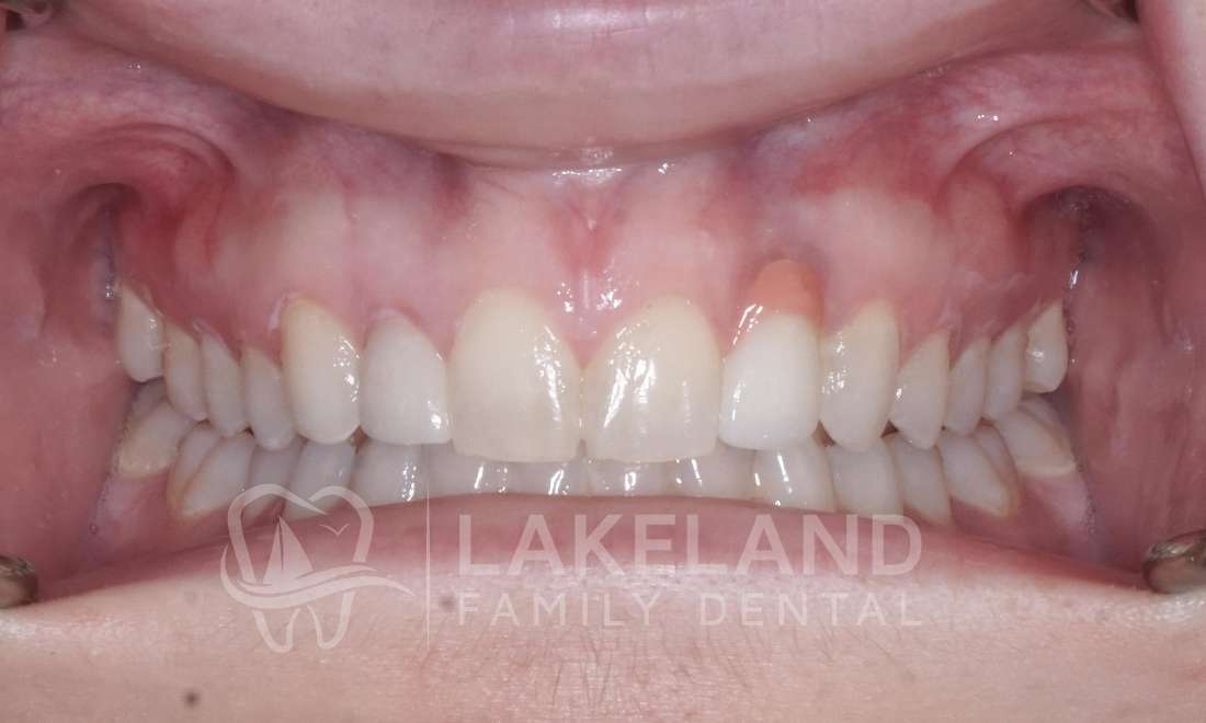 after replacing implant crown 