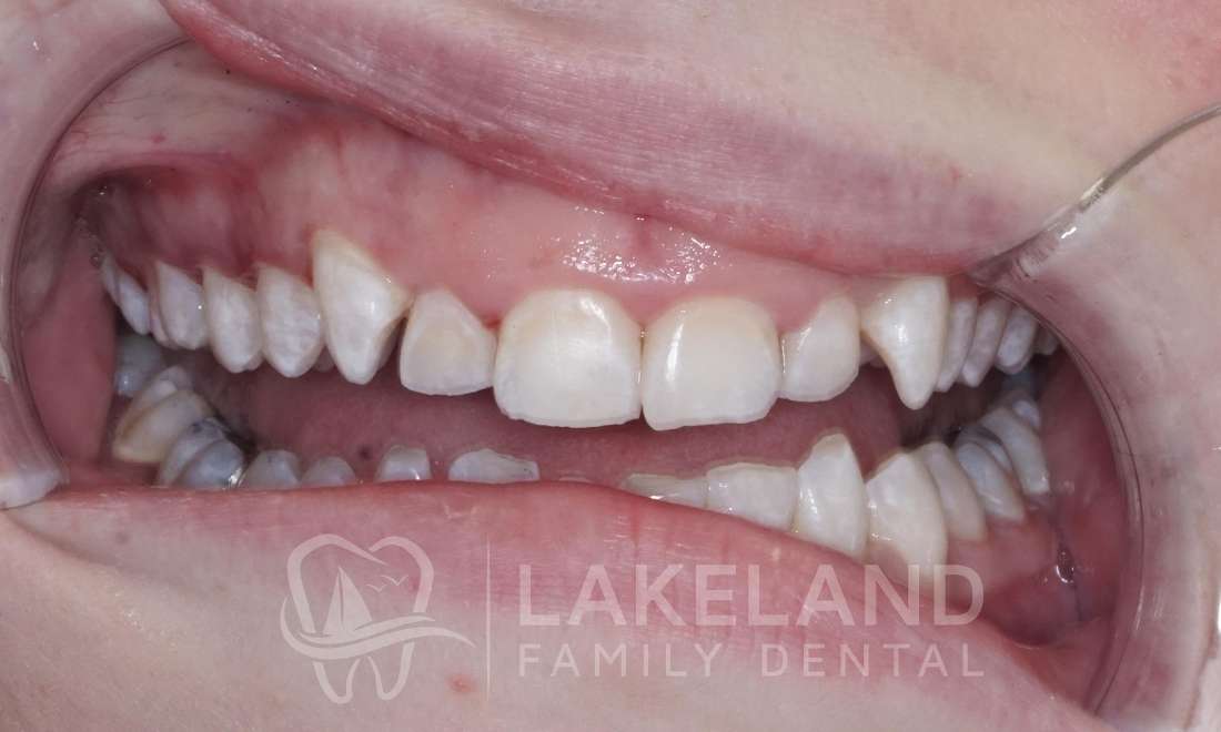 after enamel microabrasion