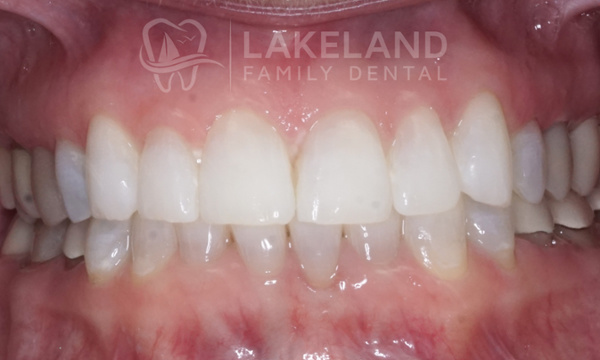 After KöR Ultra Teeth Whitening