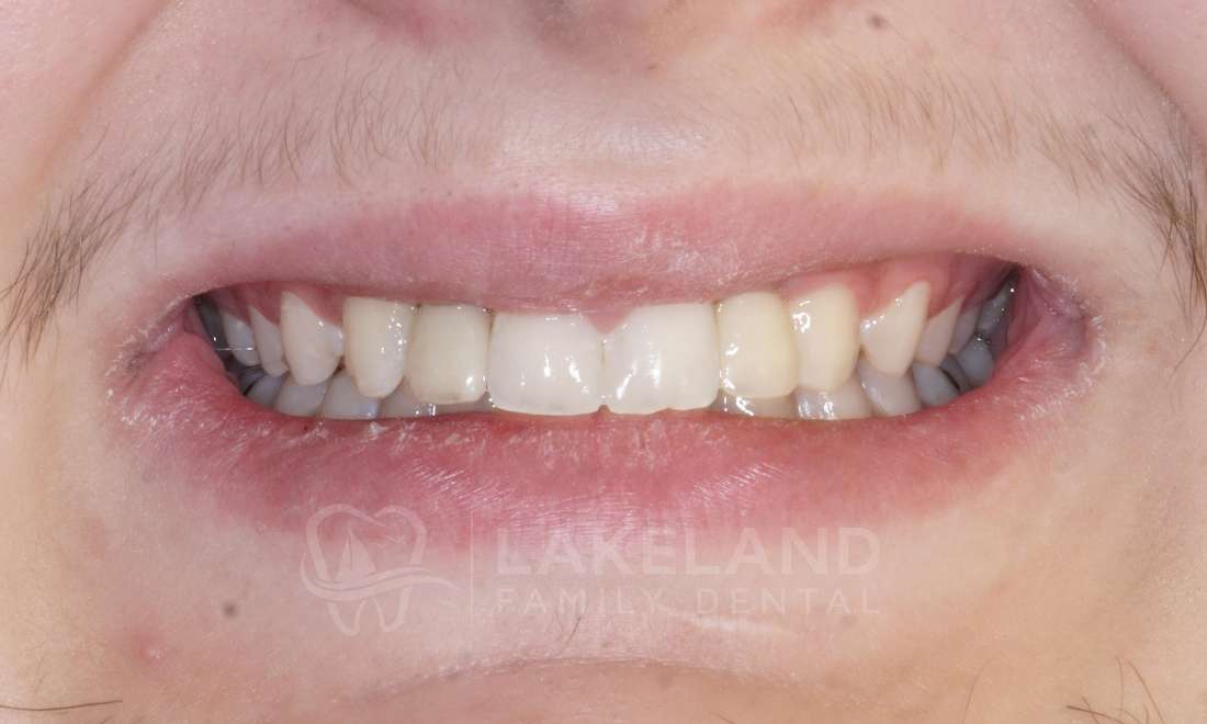 The patient has a nice smile now