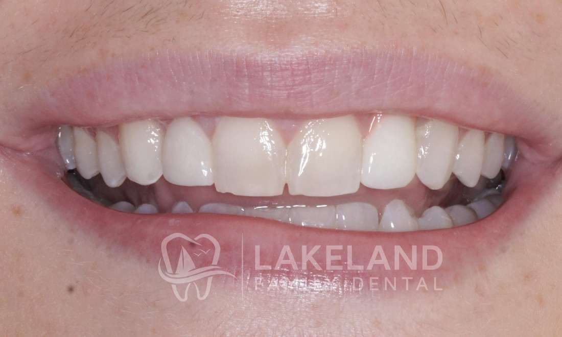 before replacing implant crown