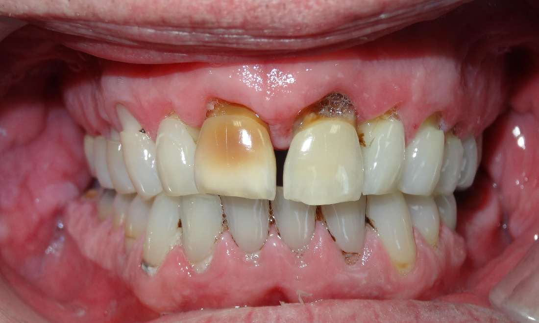 anterior bridge, before