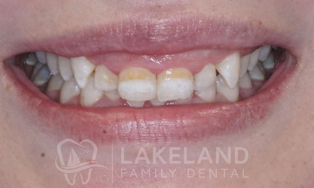 before enamel microabrasion