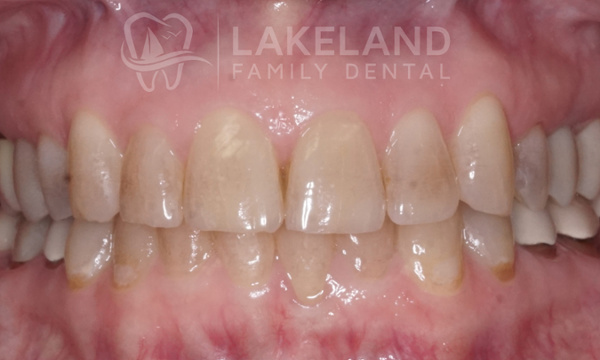 Before KöR Ultra Teeth Whitening