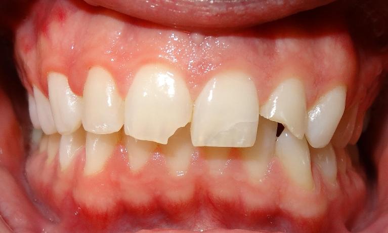 Trauma-tooth-colored-fillings-Before-Image