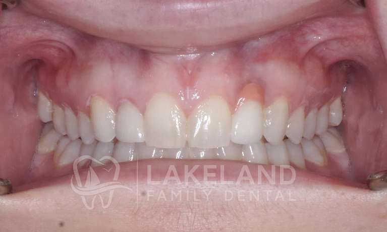 Dental-Implant-and-Crown-Repair-After-Image