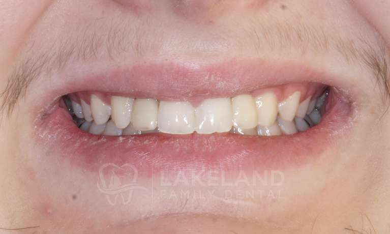 Missing-teeth-Dental-Implants-After-Image