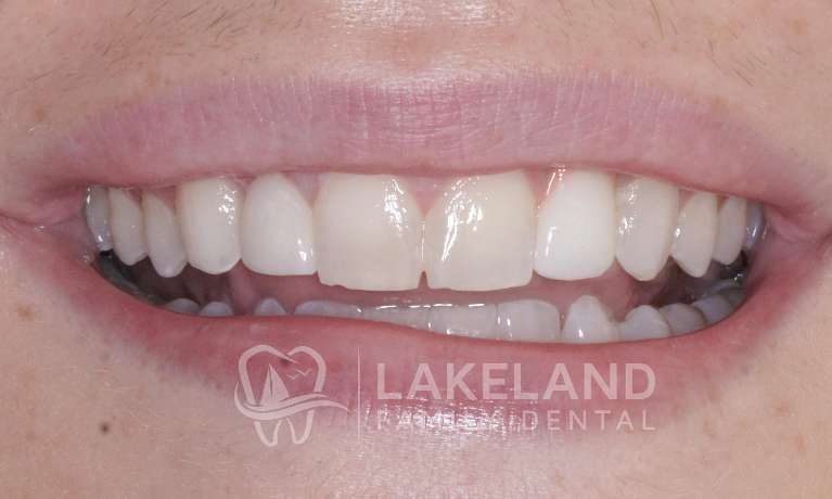 before replacing implant crown