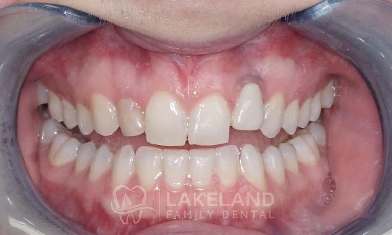 Dental-Implant-and-Crown-Repair-Before-Image