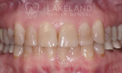 Before KöR Ultra Teeth Whitening