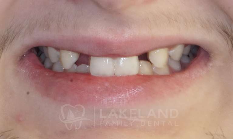 Missing-teeth-Dental-Implants-Before-Image